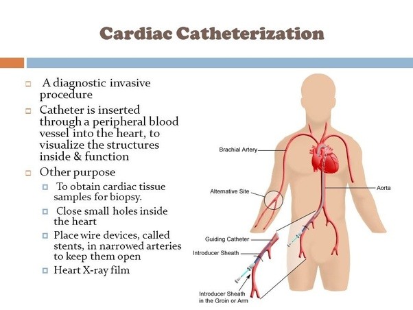 cardiac catheterization &amp; Stenting